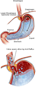 acid reflux